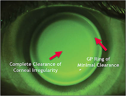 Figure 1. Fluorescein pattern of a hybrid lens fit on a keratoconic eye. There is no apical touch centrally, with a ring of minimal clearance 360º in the periphery of the GP.