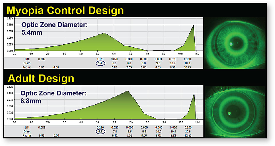 Figure 10. A myopia control design with a smaller optic zone (top) versus an adult ortho-k design with a larger optic zone (bottom).