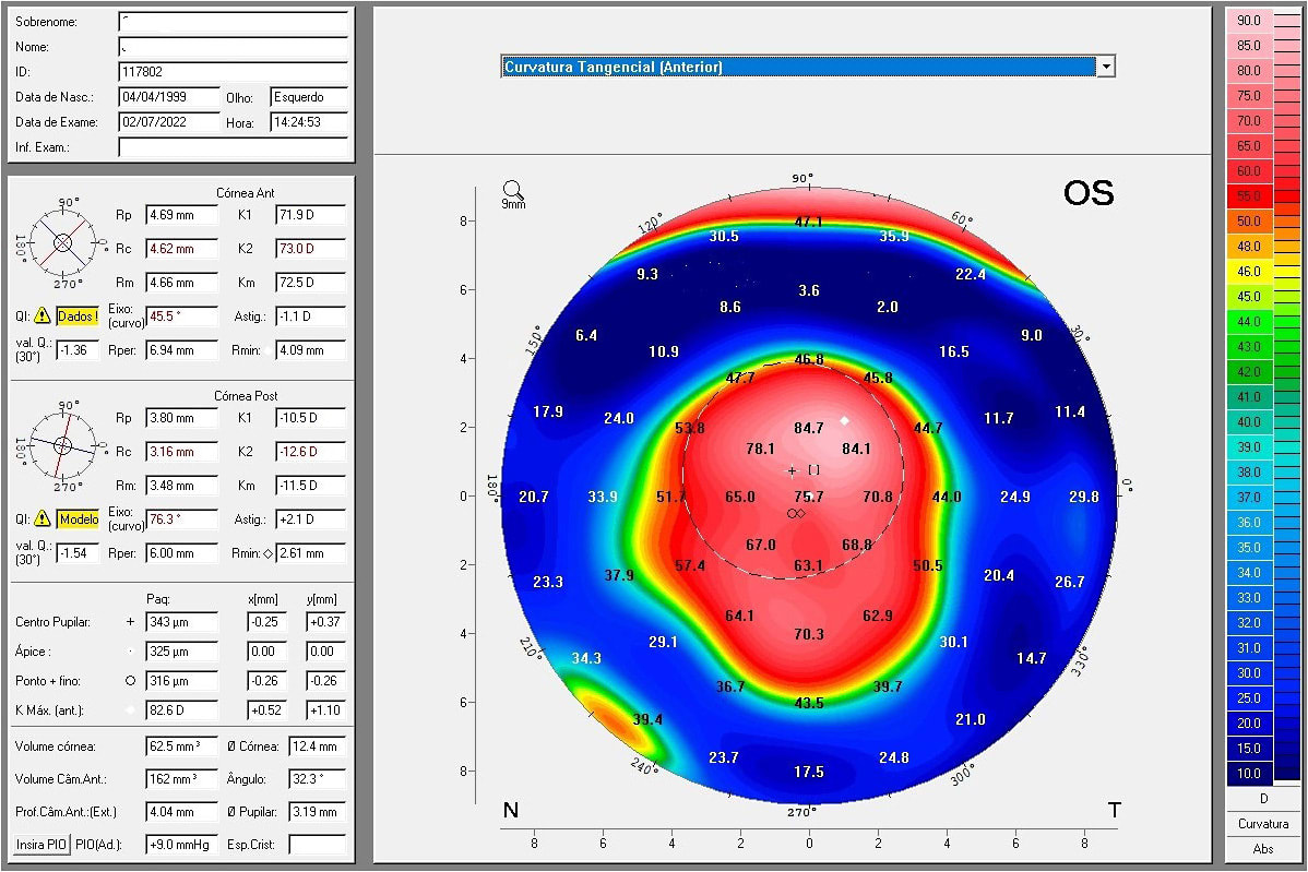 Figure 6. The anterior tangential map from corneal tomography.