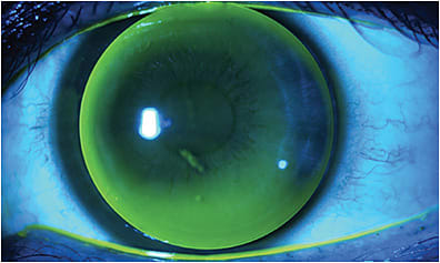 Figure 8. A flat-fitting toric corneal GP contact lens on a toric cornea.