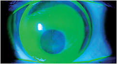 Figure 3. A spherical intralimbal GP lens on a cornea that has PMD.