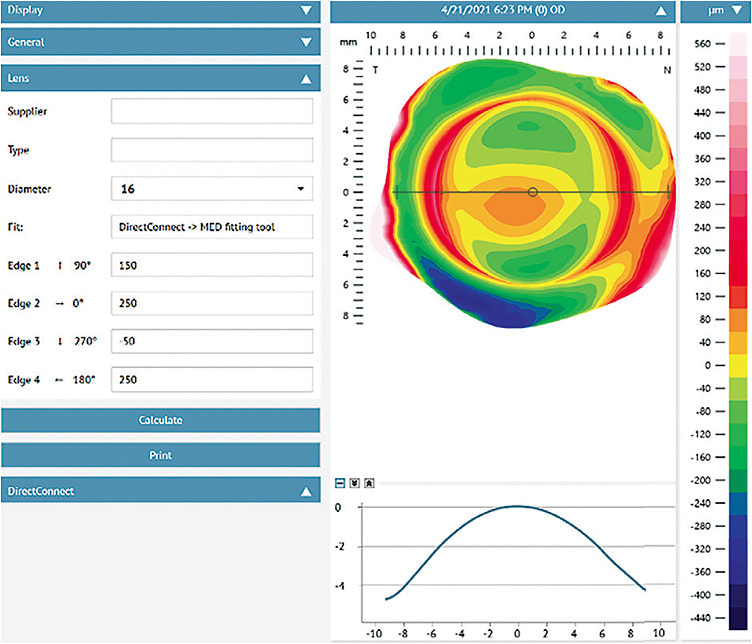 Figure 11. For the same eye as that in Figure 10, a lens fit tool can export the data directly into a manufacturer’s portal, allowing the practitioner to then make adjustments, enter lens prescription data from their application, and send the data directly to consultation for ordering. Image courtesy of Jason Jedlicka, OD