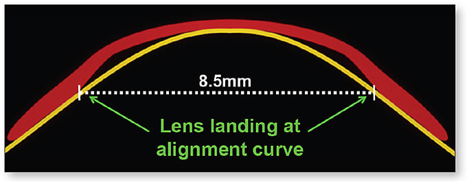 Figure 7. Ortho-k lenses “land” on the eye at the alignment curve. A corneal height differential &gt; 30µm between the two primary meridians at this chord length (8.5mm in the above lens) suggests that lens toricity will improve landing 360º around.