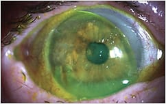 Figure 3. The patient wears high-Dk disposable soft lenses at night for corneal coverage and to reduce ocular desiccation.