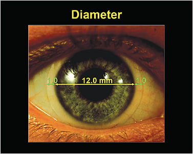 Figure 6. Soft lens on eye. The VID measures 12.0mm, with 1.0mm coverage of the lens on either side of limbus (nasal and temporal).