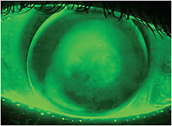 Figure 1. Photo captured from a new multifunction topographer. Note the excellent resolution of the corneal staining and of the GP lens fluorescein pattern.