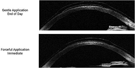 Figure 5. Comparison of lens application force on hybrid lens fitting relationship via wide-angle OCT. (Top) A hybrid lens fitting relationship at the end of the day after gentle lens application. Note the gentle touch of the inner landing zone on the cornea and the adequate central vault. The lens is easy to remove from the eye. (Bottom) The same hybrid lens evaluated immediately after forceful application; note the loss of central clearance and the bearing of the inner landing zone on the cornea. This lens was very difficult to remove.