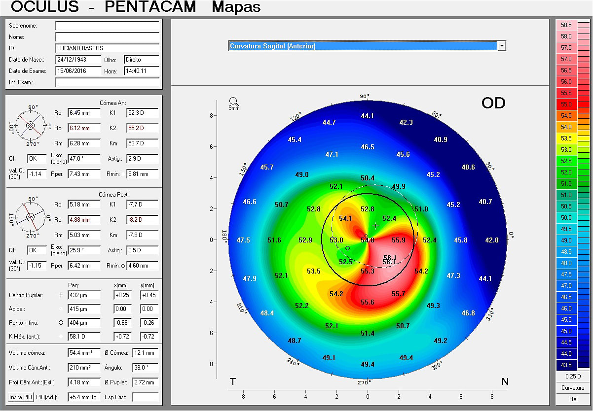 Figure 3. Sagittal curve map in 2016 (OD).