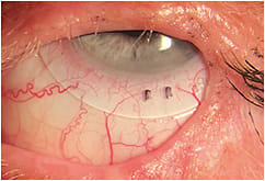 Figure 2. Scleral lens OS for management of lagophthalmos.