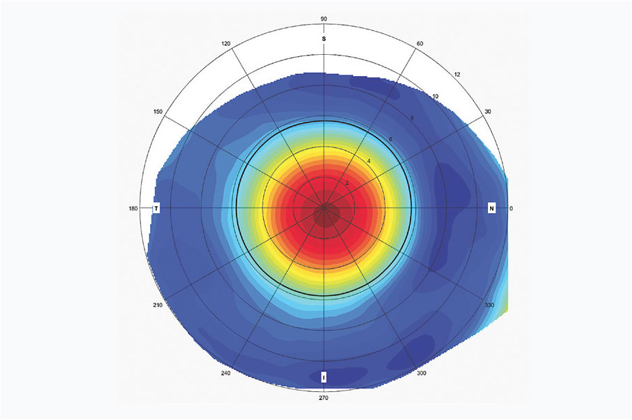 Figure 8. Scleral elevation map shows that the Case 1 patient’s right sclera has a spherical shape.