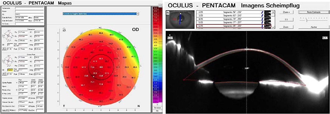 Figures 8. (A) OD anterior sagittal curvature and (B) the Scheimpflug image