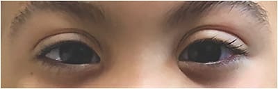 Figure 3. Soft lenses can improve the cosmetic appearance and visual quality in children who have Marfan syndrome.