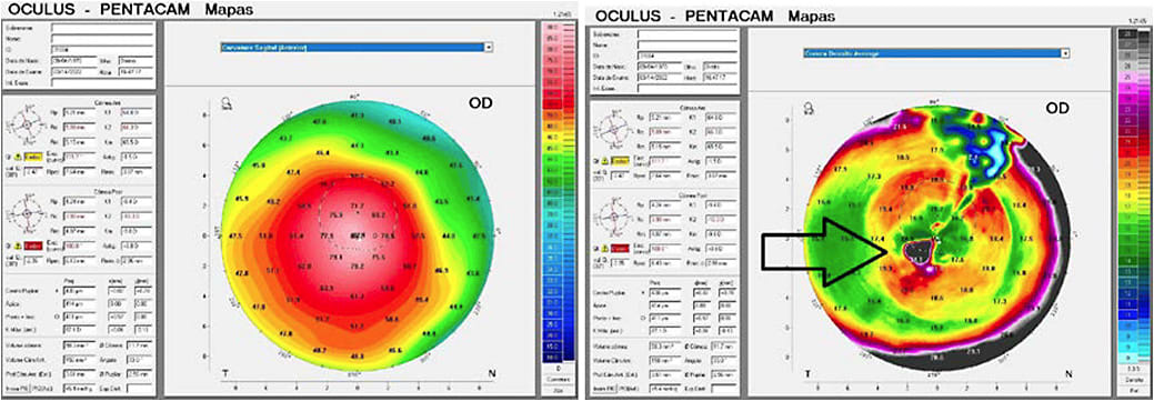 Figures 3. (A) Anterior sagittal curve and (B) corneal density average maps