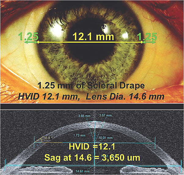 Figure 2. (Top) The corneal diameter plus 2.50mm equals the overall soft lens diameter. (Bottom) Our patient&#8217;s OCT image showing a sagittal height at 14.6mm of 3,650 microns.