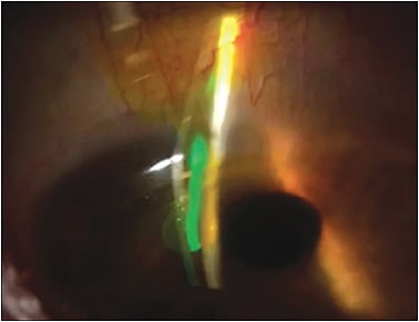 Figure 4. Image of fluorescein entering the fluid reservoir in a toric pattern.