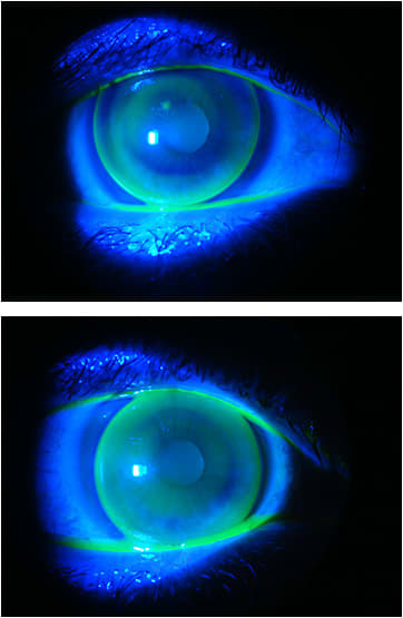 Figures 5 and 6. OD with a lesion evidenced by fluorescein, OS with an optimal fit.