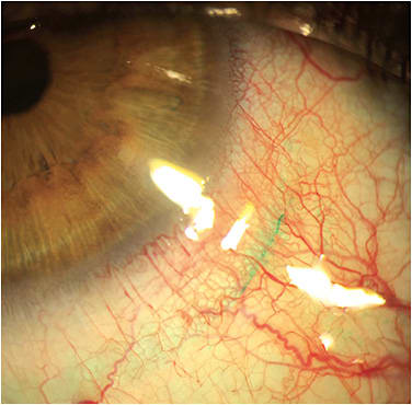 Figure 2. Arcuate conjunctival staining with lissamine green, indicating localized lens impingement in the conjunctival tissue. Courtesy of Hector Velasquez