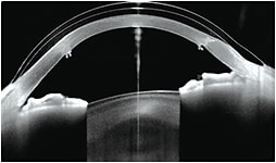 Figure 6. Notch that includes the rounding and axial lifting of the edge, in a patient who underwent penetrating keratoplasty. Image courtesy of Omar Sámano.