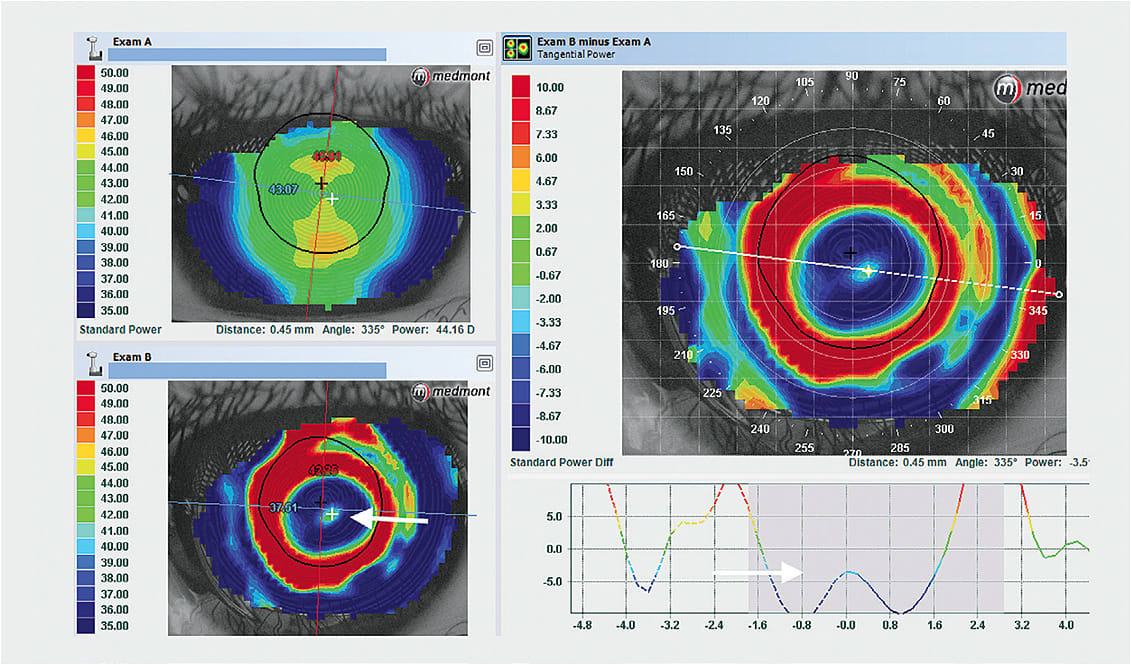 Figure 6. A false central island appears as a central peak within the treatment zone that has a topographical difference map value of &lt; 0.00D (Arrow). This is caused by a flat-fitting lens, and patients will have corneal staining upon lens removal from epithelial damage.