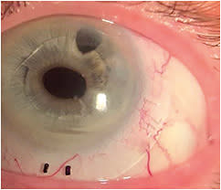 Figure 3. A 16.5mm scleral lens vaulting a temporal pinguecula.