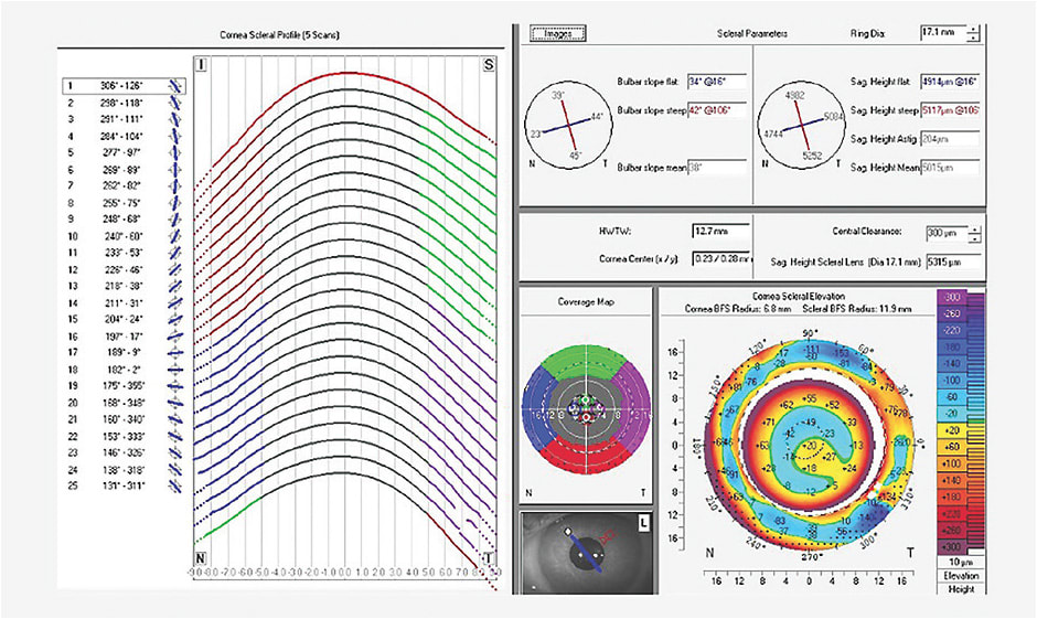 Figure 17. Scan of the Case 4 patient’s left eye. The eleva-tion map shows a quadrant-localized area of elevation between 1 o’clock and 3 o’clock, which may have been the reason for the discomfort and debris flow.