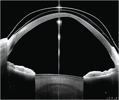 Figure 8. Left eye of the patient, which presents a severe keratoconus accompanied by nasal and temporal pingueculae. The lens has two notches. The largest notch is on the nasal side. Both have poor finished edges, as they lack axial lift. In addition, the edge of the nasal side is sharp. Image courtesy of Omar Sámano.