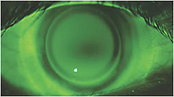 Figure 2. Regular-weighted sodium fluorescein can be placed in the bowl of a newer hybrid lens for irregular corneas prior to lens application to visualize the lens fit.