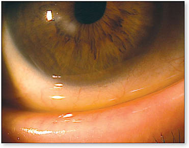 Figure 3. Ectropion and stromal scar from a previous ulcer in a patient who has AKC OD.