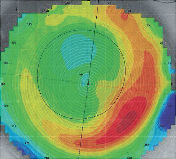 Figure 1. Corneal topography, axial power map of a post-LASIK cornea, OD, 40.6/42.5 @ 073.