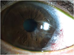 Figure 2. Vascularization due to conjunctival prolapse.