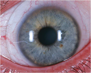 Figure 1. Image of a precise, personalized scleral lens on eye.