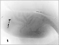 Figure 1. Meibography of a lens wearer showing changes in gland structure.