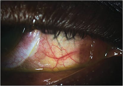 Figure 1. Scleral lens haptic bearing on a pinguecula. Image courtesy of Greg DeNaeyer, OD