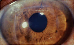 Figure 1. A surviving square corneal transplant performed by Dr. Max Fine in the 1940s.