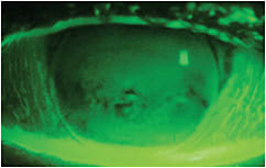 Figure 3. Impression ring after removal of the GP lens.