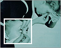 Figure 3. These images from the 1930s show that scleral lens application and removal techniques have not changed in almost 100 years.