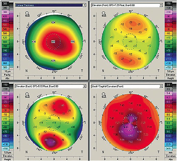 Figure 1. Asymmetric astigmatic pattern with thin pachymetry measurements.