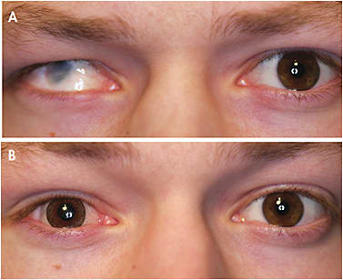 Figures 13. (A) shows an eye with congenital coloboma. (B) shows this same eye corrected with a large soft scleral hand-painted lens that has an aligned iris for maximum symmetry. Note the differing aperture size.