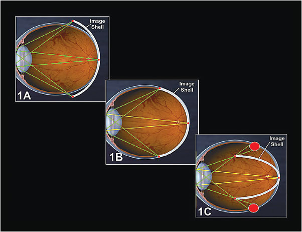 Figure 1. The image shell in a myopic child corrected with traditional spectacle lenses (A), the image shell associated with a low add power multifocal lens (B), and the image shell with a high midperipheral add power (C).