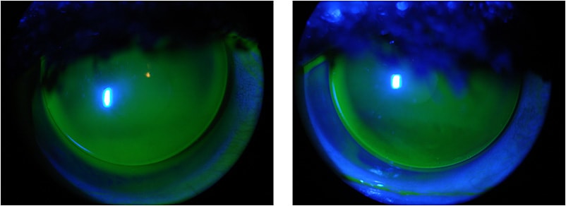 Figure 2. GP fluorescein patterns after a proper cleaning.