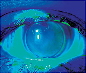 Figure 1. Hybrid lenses correct astigmatism and are a good contact lens choice for children active in sports.