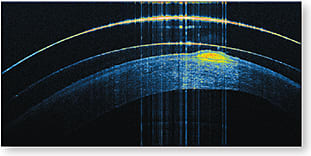 Figure 1. The OCT image with enhancement colors of the SFN on a keratoconic cornea. Some important landmarks from the top of the image to the bottom are first a scleral contact lens with an estimated thickness of 330 microns. The next band is the saline-filled fluid cell or reservoir. Using the contact lens as a guide, the fluid cell to the left and right of the SFN is somewhat more than 100 microns in depth. Last is the cornea. The SFN itself can be estimated to be just under 100 microns, and the cornea just to the right of the SFN is not much thicker than the 330 microns of the lens. This is advanced keratoconus, and I believe that the scleral lens will help to extend the life of the cornea.