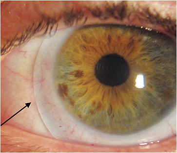 Figure 3. Nasal impingement secondary to newly formed pinguecula.