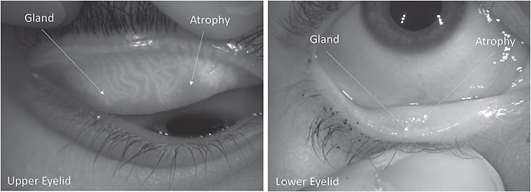 Figure 1. Meibography images. Left: Upper eyelid presents with a grade 1 meiboscore and gland tortuosity (gland deviation). Right: Lower eye presents with a grade 3 meiboscore.