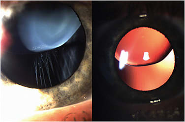 Figure 8. A subluxated lens on a patient who has Marfan syndrome.