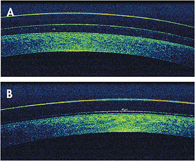 Figure 3. Settling of a hybrid lens for irregular corneas: central clearance at application (A) and after three hours of wear (B).