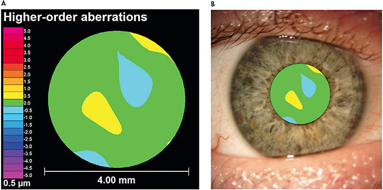 Figure 1. (A) Wavefront aberration map of a mild myopic astigmat. HO RMS = 0.19µm. (B) Wavefront aberrations are measured within the pupil.