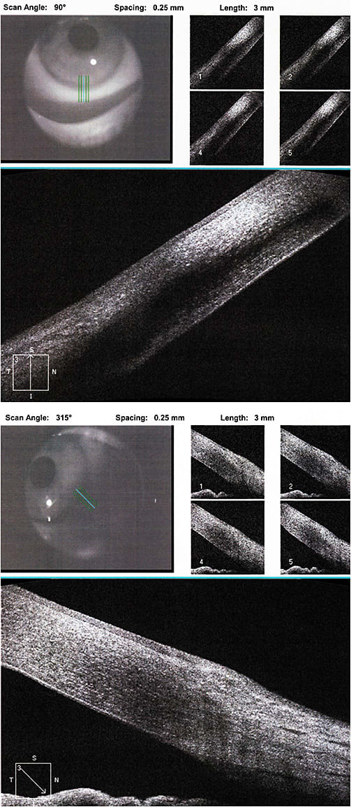 Figure 5. OCT of OD at 90º (left) and at 315º (right). A clear zone between the lipid deposits and the limbus confirms the biomicroscopy findings.