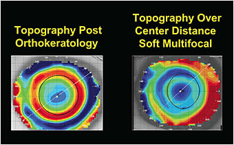 Figure 2. The power profile of a post-orthokeratology cornea resembles that of a center-distance aspheric multifocal.