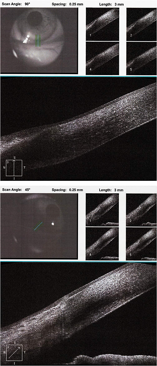 Figure 6. OCT images of OS at 90º (left) and at 45º (right), again showing a clear zone between the lipid deposits and the limbus.